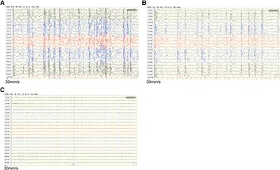 A novel mutation in ryanodine receptor 2 (RYR2) genes at c.12670G>T associated with focal epilepsy in a 3-year-old child